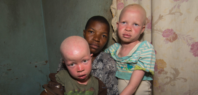 Personnes atteintes d'albinisme