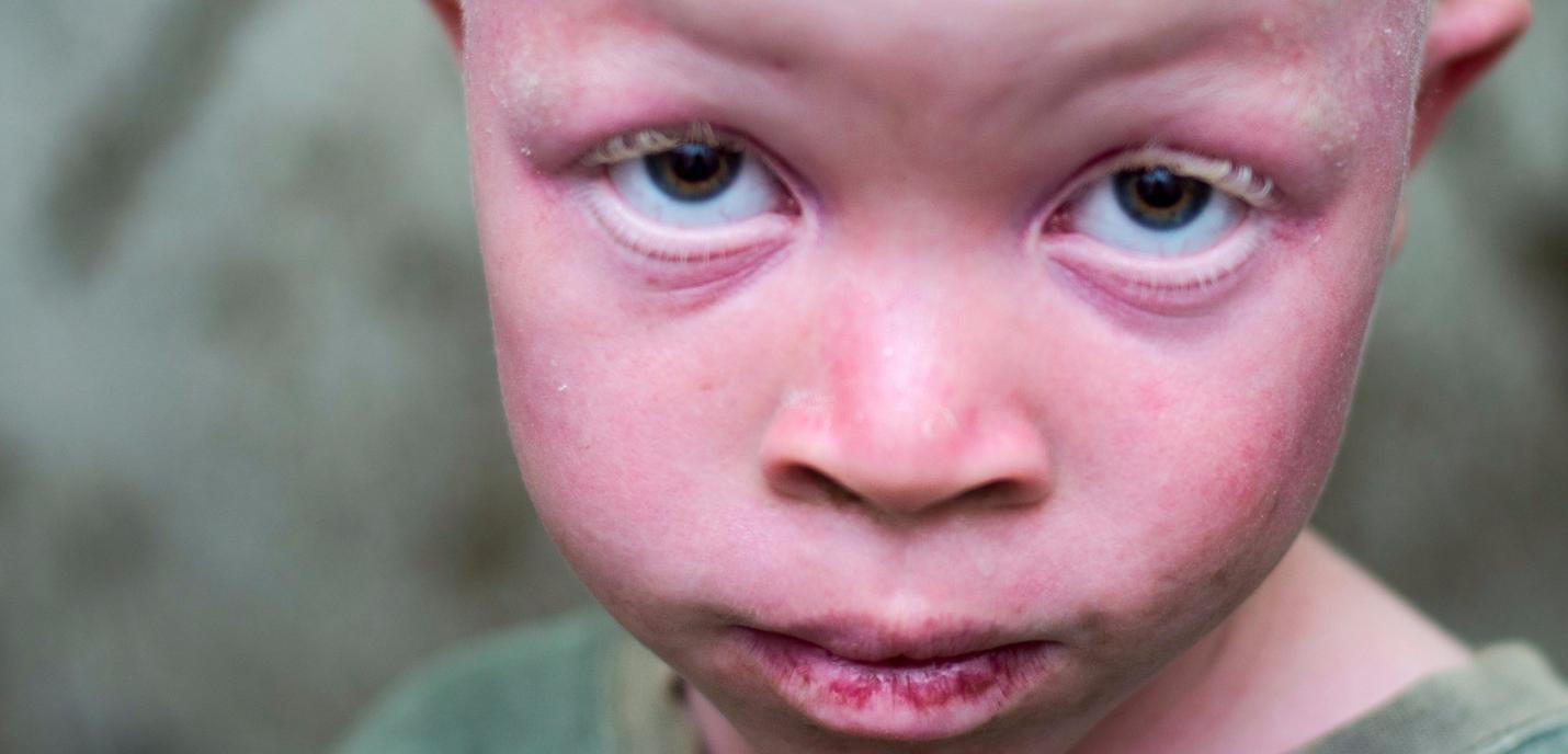 Une personne albinos